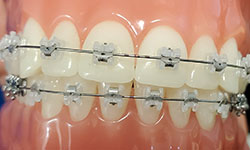 self-ligating braces